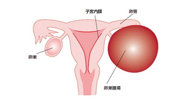 卵巣腫瘍のイラスト