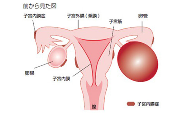 前から見た子宮内膜症のイラスト