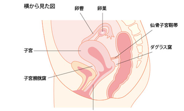 横から見た子宮内膜症のイラスト